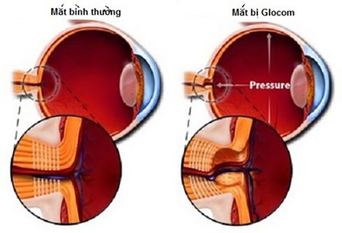 Triệu chứng sớm dễ nhận biết của bệnh Glôcôm