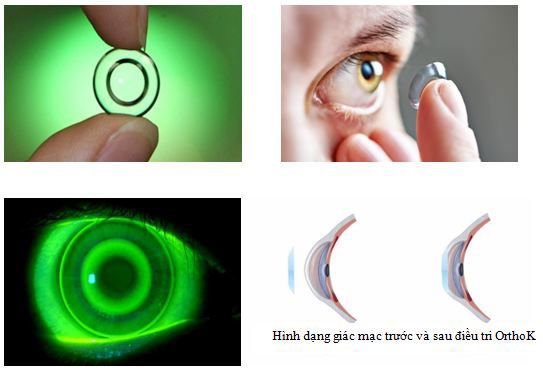 Điều trị cận thị bằng kính tiếp xúc Ortho-k