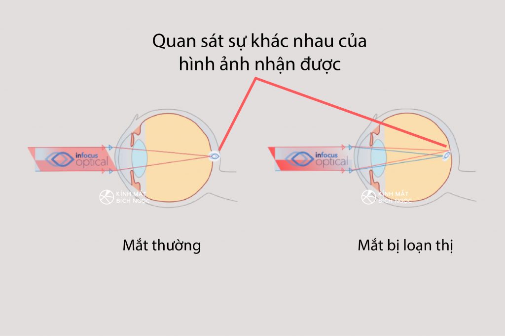 LOẠN THỊ CÓ NÊN ĐEO KÍNH THƯỜNG XUYÊN KHÔNG?
